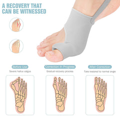 HYGGEAR CORRECTOR DE JUANETES Y HALLUX VALGUS PARA DEDO GORDO DEL PIE